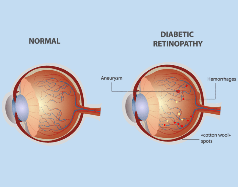 Diabetic Eye Care