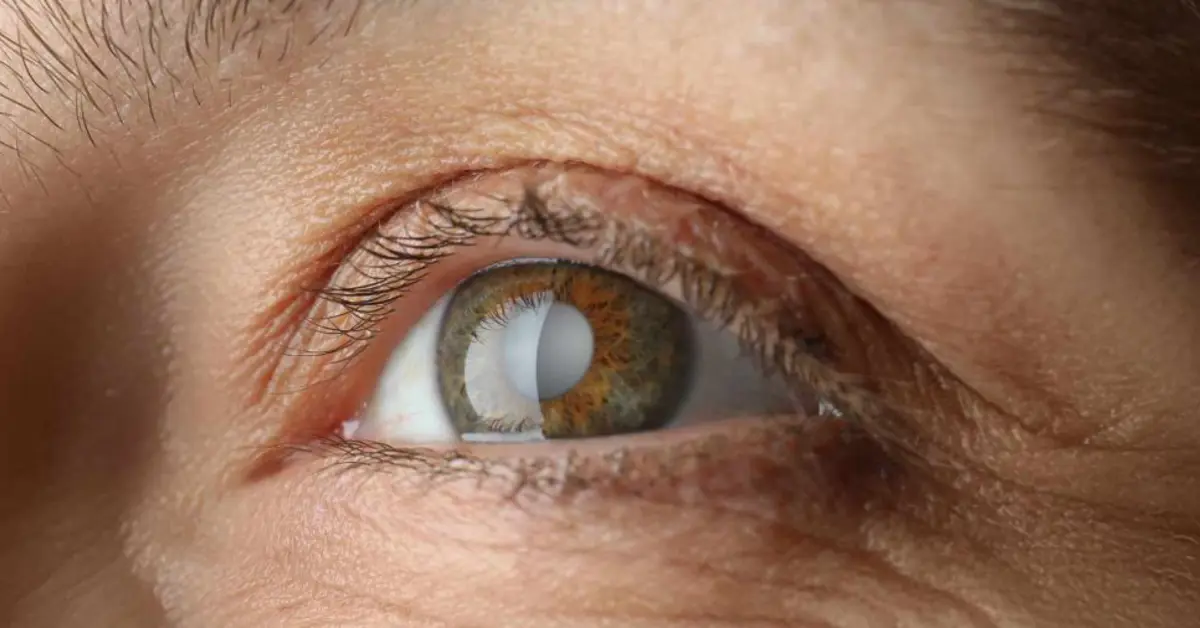 Screening and Treatment for Cataract